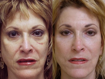 64 year old female with loss of volume in face before 1234197