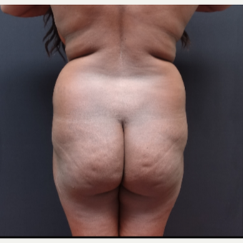 25-34 year old woman treated with Tumescent Liposuction before 3363757