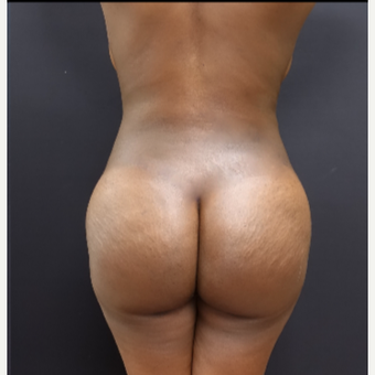 25-34 year old woman treated with Tumescent Liposuction after 3363757