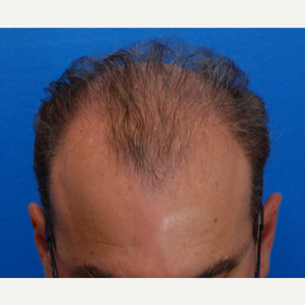 45-54 year old man treated with Hair Transplant before 3417087
