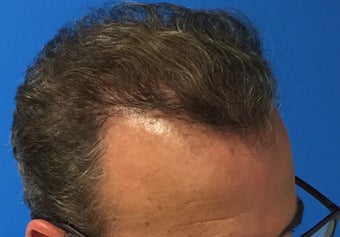 45-54 year old man treated with Hair Transplant 3417087