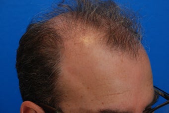 45-54 year old man treated with Hair Transplant 3417087