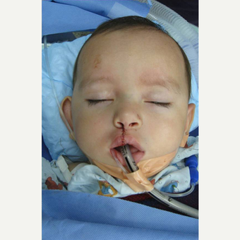 Cleft Lip And Palate Repair after 3711062