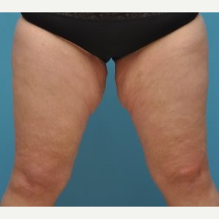 25-34 year old woman treated with Thigh Lift before 3076214