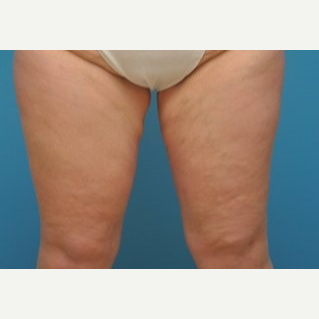 25-34 year old woman treated with Thigh Lift after 3076214