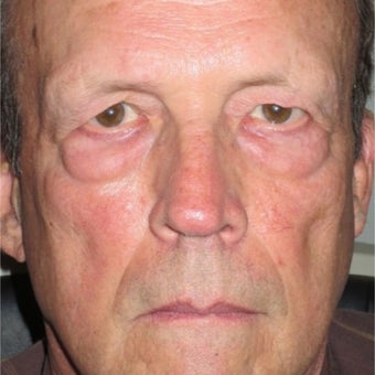 55-64 year old man treated with Eyelid Surgery before 1685260