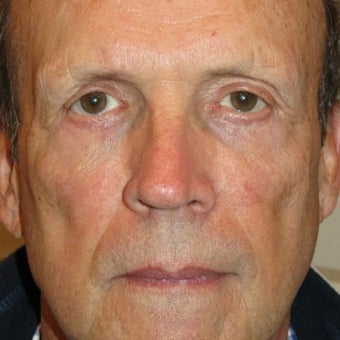 55-64 year old man treated with Eyelid Surgery after 1685260