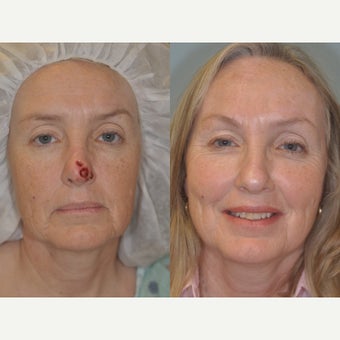 Nasal Reconstruction with a forehead flap before 2042436