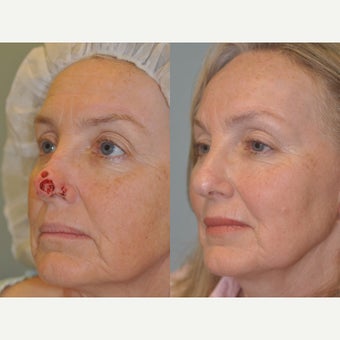 Nasal Reconstruction with a forehead flap after 2042436