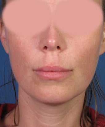 Upper Lip Lift with Subnasale Incision to Shorten the Upper Lip before 1155086