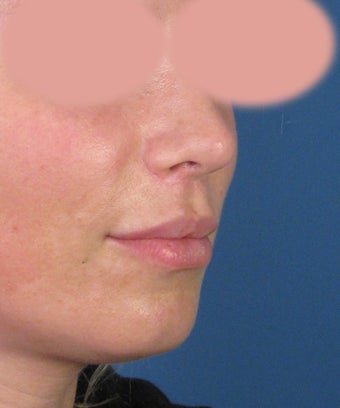 Upper Lip Lift with Subnasale Incision to Shorten the Upper Lip 1155086