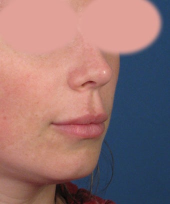 Upper Lip Lift with Subnasale Incision to Shorten the Upper Lip 1155086