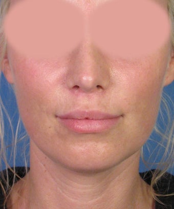 Upper Lip Lift with Subnasale Incision to Shorten the Upper Lip after 1155086
