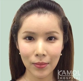 MTF Facial Feminization Surgery after 2704818