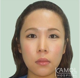 MTF Facial Feminization Surgery before 2704818