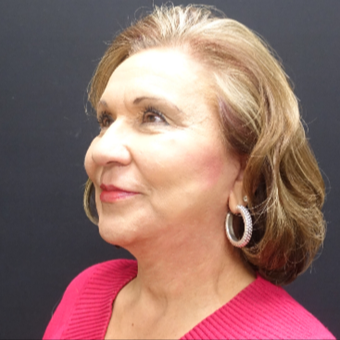 65-74 year old woman treated with Fat Transfer and Facelift after 3244868