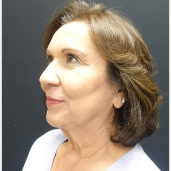 65-74 year old woman treated with Fat Transfer and Facelift before 3244868
