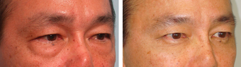 Asian Male Blepharoplasty before 1148212