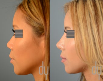 Asian Rhinoplasty with Rib Cartilage Harvest and Diced Cartilage Fascia (DCF) before 1449193