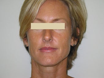 Advanta Lip Augmentation before 147387