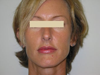 Advanta Lip Augmentation after 147387