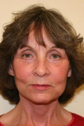 Fractional Laser after 1623812