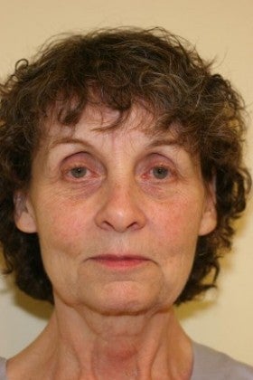 Fractional Laser before 1623812