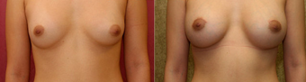 breast implants revision after 302665