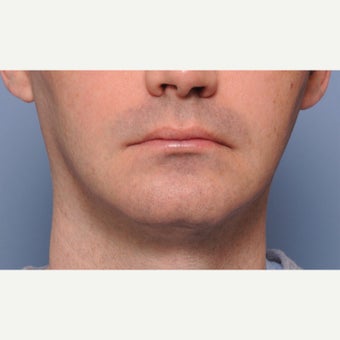 18-24 year old man treated with Chin Surgery before 2212498