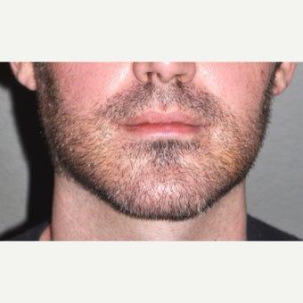 18-24 year old man treated with Chin Surgery after 2212498