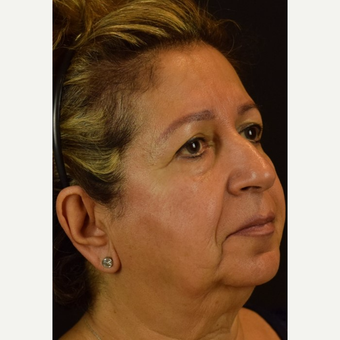 Jawline improvement and cheek lift with NovaLift - Non Surgical Facial Rejuvenation before 2839341