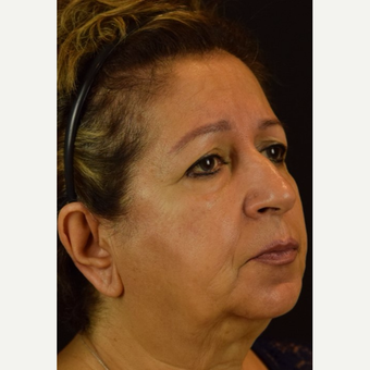 Jawline improvement and cheek lift with NovaLift - Non Surgical Facial Rejuvenation after 2839341