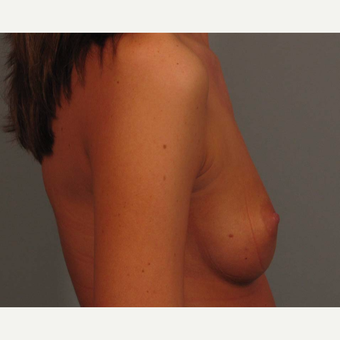 18-24 year old woman treated with Endo-Axillary Breast Augmentation before 3464984