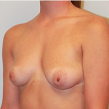 Breast Lift with Implants before 2073581