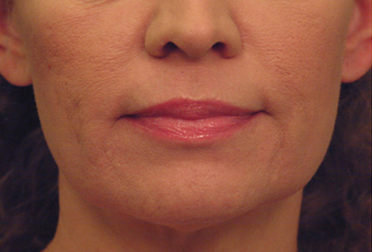 Laser Skin Tightening with acne scar improvement after 53749