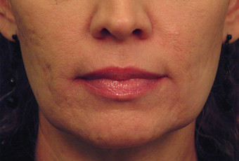 Laser Skin Tightening with acne scar improvement before 53749