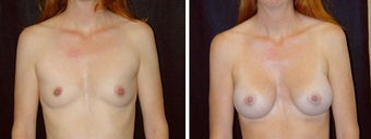 29 year old female, breast augmentation, San Francisco, California before 628335