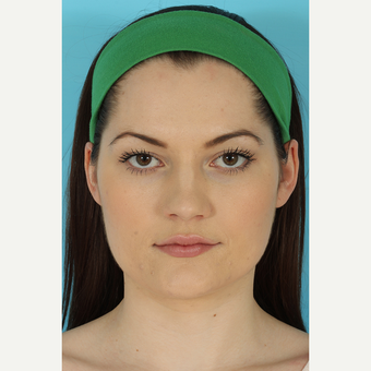 25-34 year old woman treated with Rhinoplasty before 3691098