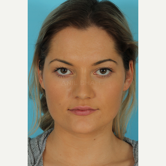 25-34 year old woman treated with Rhinoplasty after 3691098