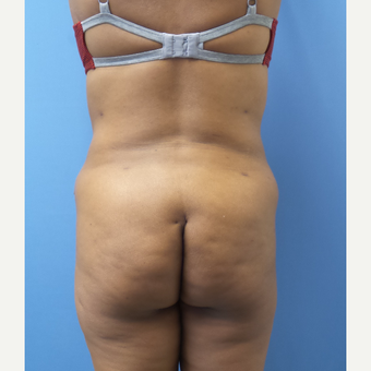 35-44 year old woman treated with Liposuction after 3168285