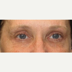 50 year old woman treated with Eyelid Surgery before 3026084