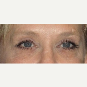 50 year old woman treated with Eyelid Surgery after 3026084