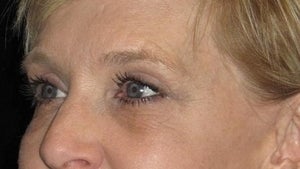 50 year old woman treated with Eyelid Surgery 3026084
