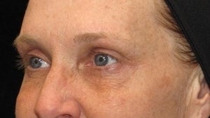 50 year old woman treated with Eyelid Surgery 3026084
