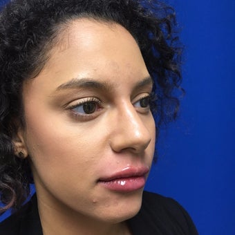 Injectable Fillers to Augment Lips for This 32 Year Old Woman after 3295256