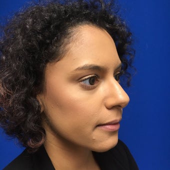 Injectable Fillers to Augment Lips for This 32 Year Old Woman before 3295256