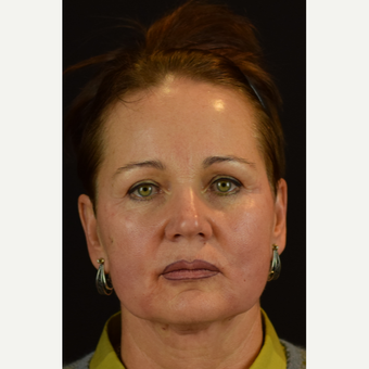 Novathread Lift to the Cheeks and Soften the Corner of the Mouth after 3583078