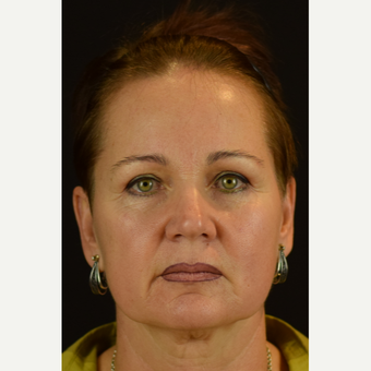 Novathread Lift to the Cheeks and Soften the Corner of the Mouth before 3583078