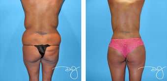 Butt Augmentation before 1006349