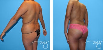 Butt Augmentation after 1006349
